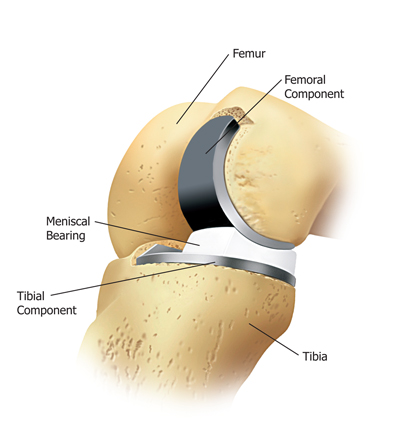 Partial Knee Replacement India