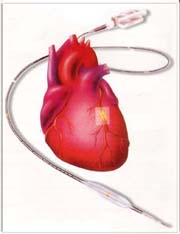 Coronary Angioplasty Surgery Cost In Mumbai Delhi India