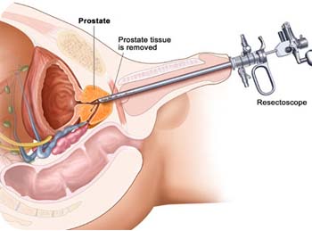 enlarged prostate surgery cost)